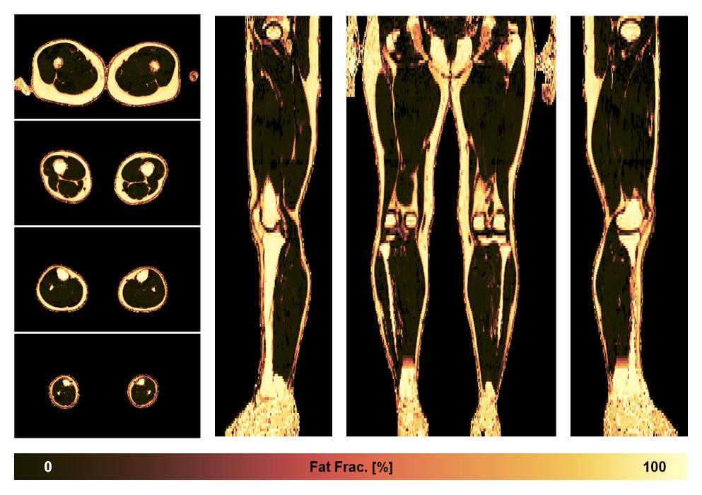 The fat fraction of the lower extremity obtained from the dixon reconstruction for muscle water fat quantification.